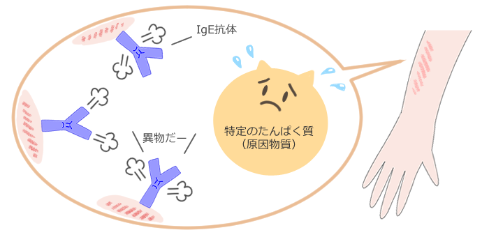 特定のたんぱく質（原因物質）を遺物だと認識すると、血液中のIgE抗体が反応し、アレルギー症状が出ます。